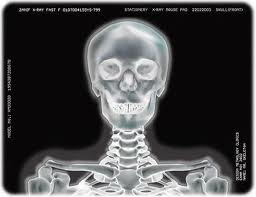 Medical_X-Ray_with_Silver_Film_Image